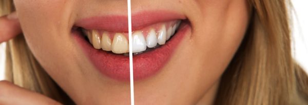 Dientes más Blancos Sonrisa Mujer Cuidado Dental